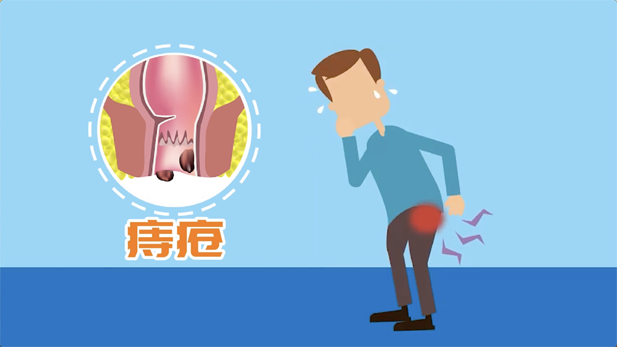 每2人就有1人患有的疾病——痔疮